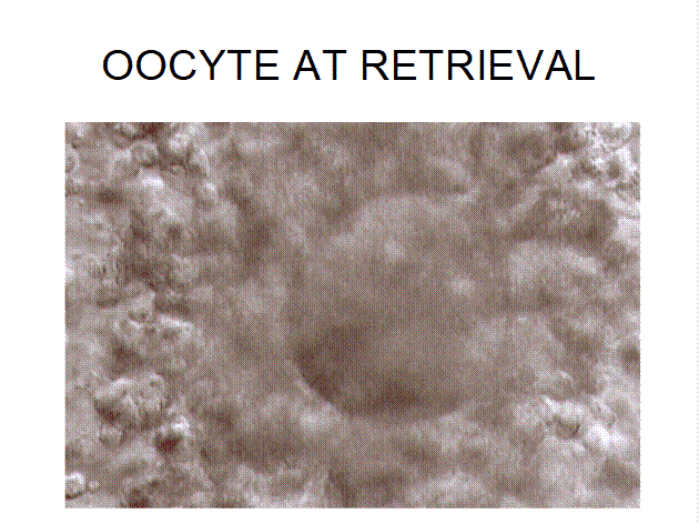 Oocyte Retrieval